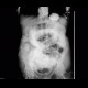 Crohn's disease, small bowel obstruction, ileus: RF - Fluoroscopy